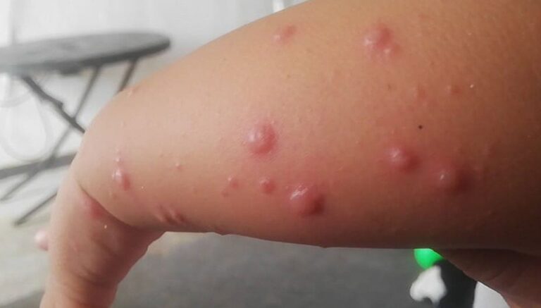 Confirman brote de virus coxsackie en primaria; suspenden clases