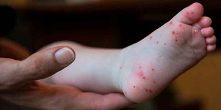 Tehuantepec alerta sobre virus Coxsackie